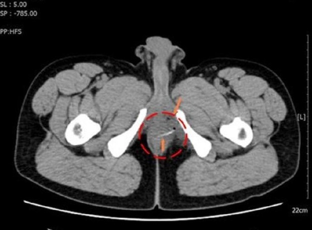 Tưởng bị ung thư, đi khám phát hiện xương cá đâm thủng ruột - Ảnh 2.