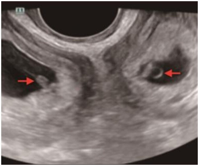 Người mẹ có 2 tử cung, mỗi tử cung đều có một bào thai.
