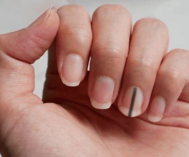 Móng tay xuất hiện đường vệt đen báo hiệu cơ thể đang báo động (Ảnh minh hoạ)