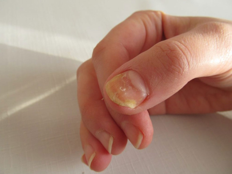 Xuất hiện những dấu hiệu lạ trên móng tay bạn nên đến thăm khám bác sĩ càng sớm càng tốt (Ảnh minh hoạ)