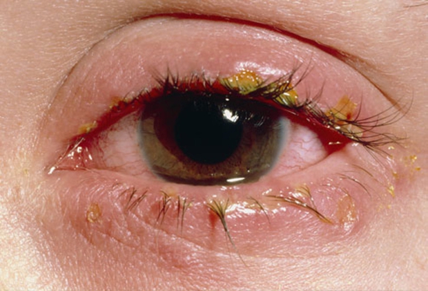 6 kiểu gỉ mắt cảnh báo bệnh nhãn khoa nghiêm trọng nhưng ít ai quan tâm - Ảnh 4.