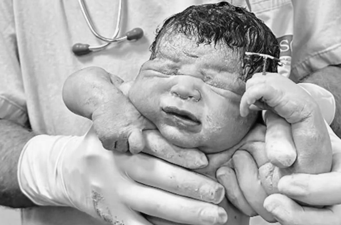 Bé Matheus được bác sĩ đặt vòng tránh thai vào tay và quay lại khoảnh khắc đáng nhớ khi chào đời. Ảnh: Newsflash