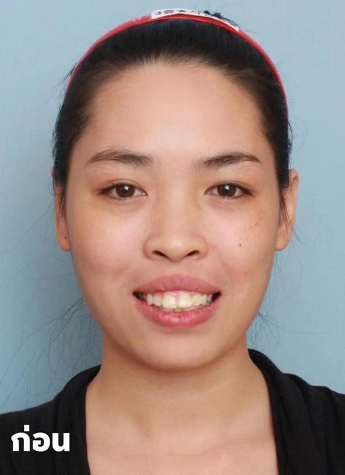 Vũ Thanh Quỳnh được biết đến rộng rãi vào năm 2014 khi tham gia chương trình thực tế Change Life - Thay đổi cuộc sống. Trước phẫu thuật thẩm mỹ, cô sở hữu gương mặt kém sắc với khuyết điểm lớn là hàm hô, gương mặt thô, và ánh nhìn thiếu tự tin, khiến cô gặp nhiều rào cản trong cuộc sống và công việc.