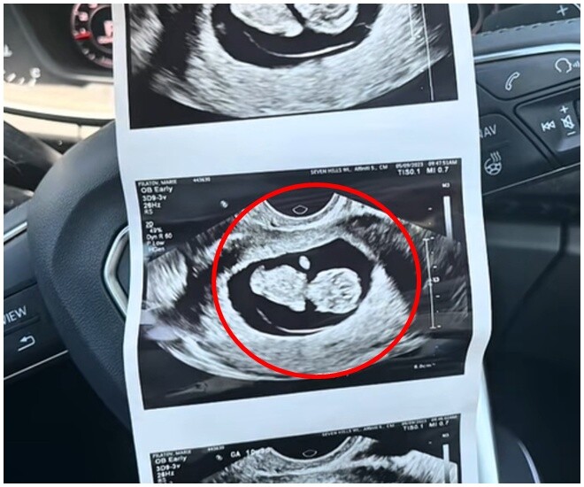 Kết quả siêu âm cho thấy em bé thiếu bàn tay trái.