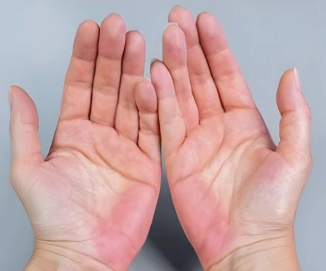 Khi chức năng gan bị suy giảm, những mạch ở bàn tay giãn nở nhiều hơn và dẫn đến ửng đỏ lòng bàn tay. (Ảnh minh hoạ)