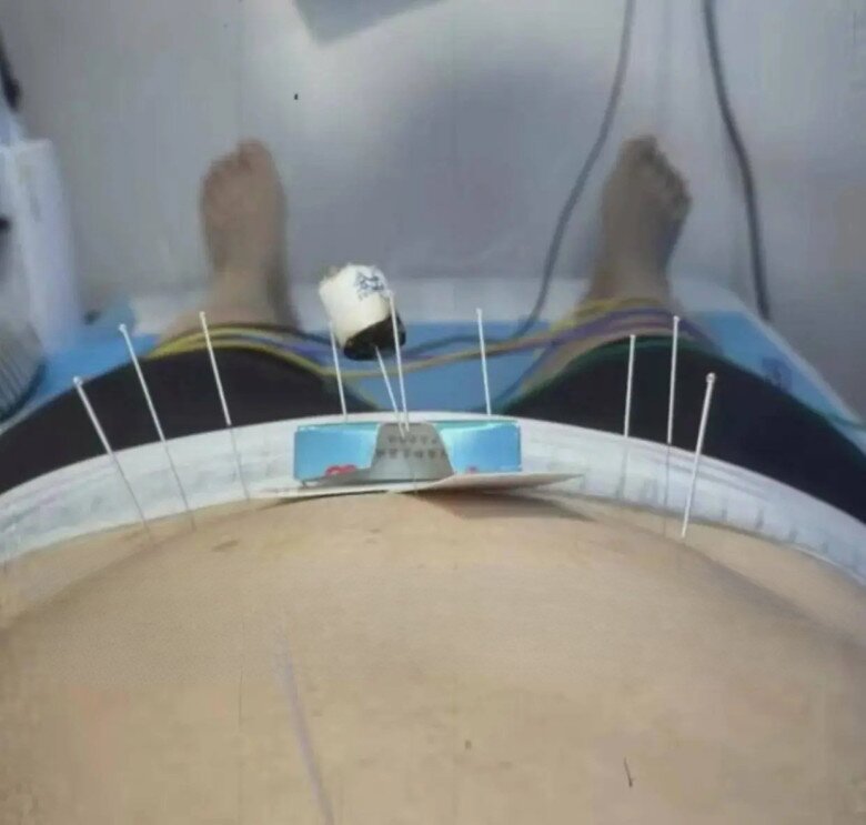 Nữ diễn viên phải chịu khoảng 200 mũi tiêm kích trứng.