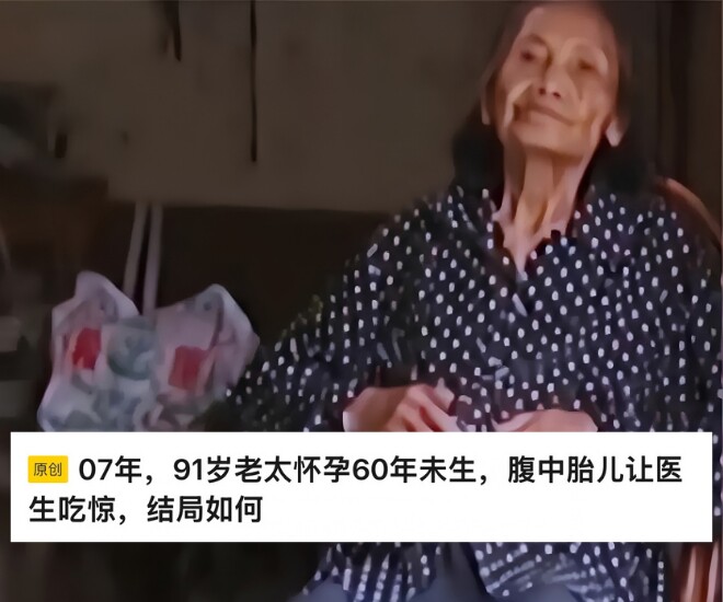 Bác sĩ phát hiện trong bụng cụ bà 91 tuổi có 1 bào thai tồn tại nhiều thập kỷ - Nguồn: Sohu.