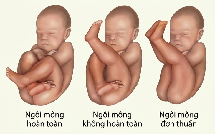3 tư thế chính của thai nhi ngôi ngược.