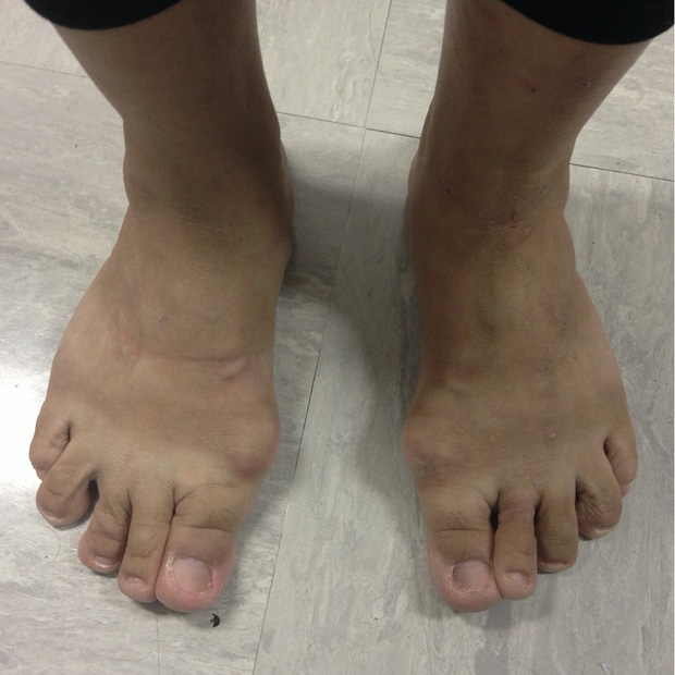 Đi giày cao gót càng cao, bàn chân càng khó phục hồi và có thể bị biến dạng, bác sĩ chỉnh hình hướng dẫn 6 mẹo giảm đau - Ảnh 1.
