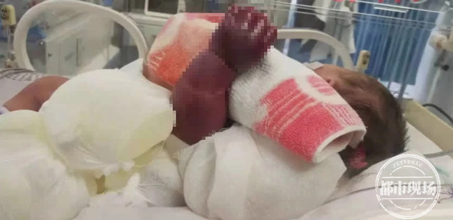Cánh tay của bé 1 ngày tuổi bỗng nhiên bầm đen, gia đình đưa đến bệnh viện mới biết do sự cẩn thận quá mức của người mẹ - Ảnh 2.