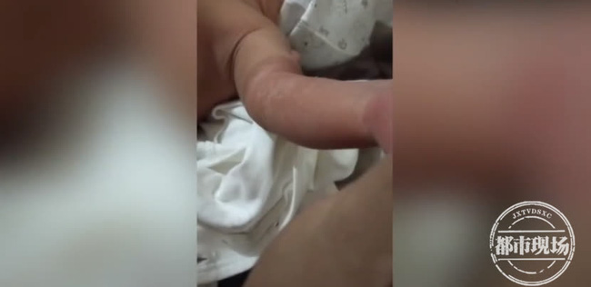 Cánh tay của bé 1 ngày tuổi bỗng nhiên bầm đen, gia đình đưa đến bệnh viện mới biết do sự cẩn thận quá mức của người mẹ - Ảnh 3.