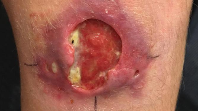 Cases of Buruli ulcer are on the rise in Victoria, with the spike linked to greater Geelong suburbs. (PR HANDOUT IMAGE PHOTO)