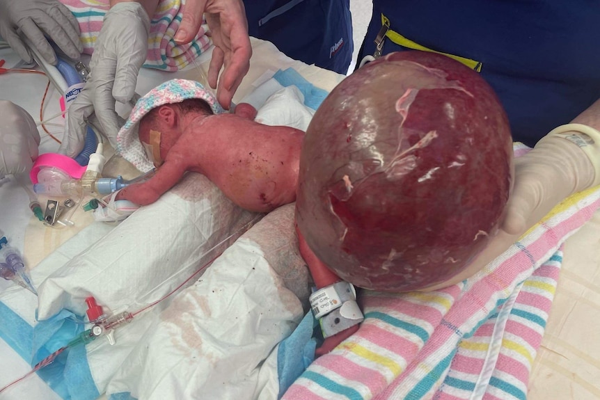 A newborn baby with a tumour bigger than her.