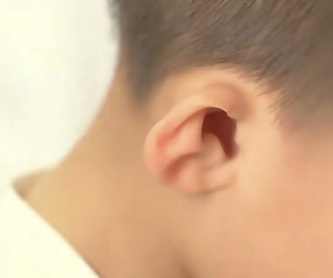 Bé trai có đôi tai biến dạng vì mẹ tiếp xúc với khói thuốc lá khi mang bầu.