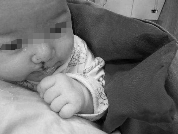 Trường hợp khác siêu âm phát hiện trẻ bị hở hàm ếch, cũng do khói thuốc gây ra - Ảnh minh hoạ.