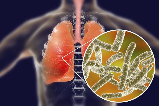 Conceptual computer illustration of Legionnaires’ disease.