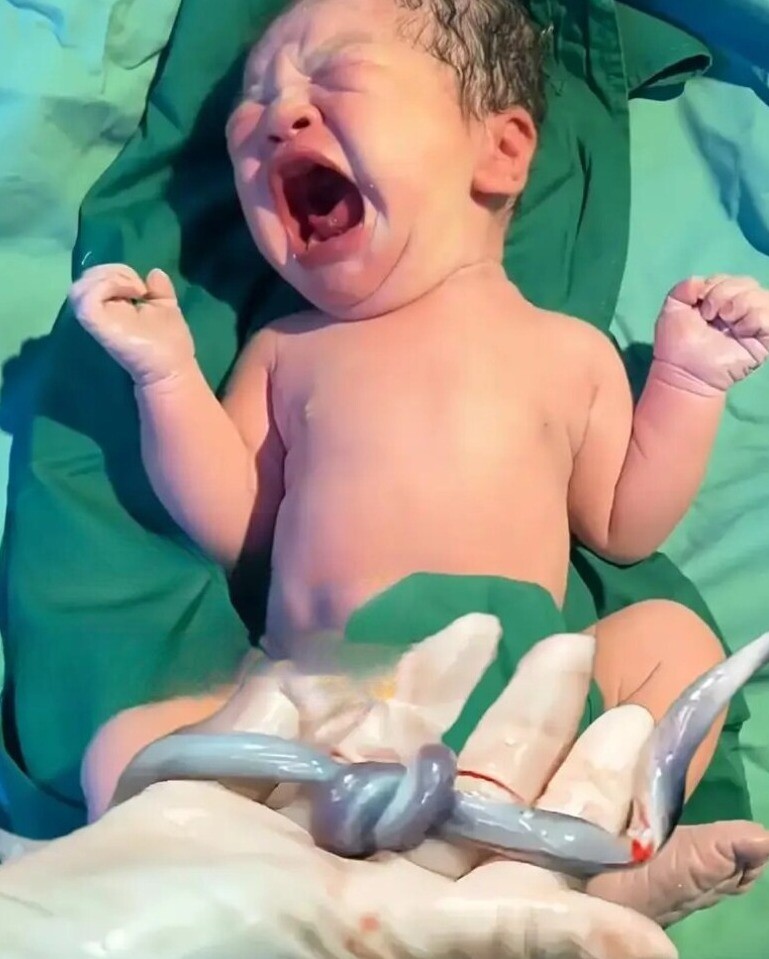 Đây là hiện tượng hiếm gặp và rất nguy hiểm cho thai nhi.