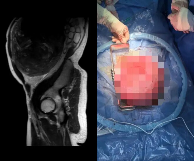 Qua thăm khám, bác sĩ tá hoả phát hiện khối u xơ 30cm trong ổ bụng.