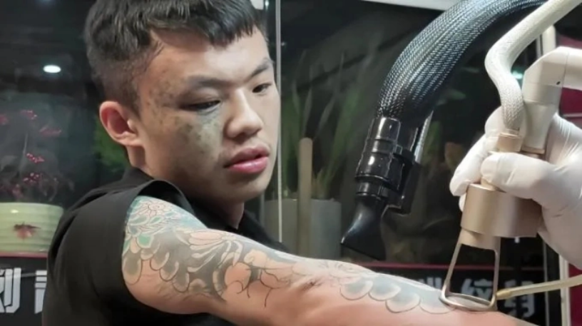 Xia Chaoyong, 19 tuổi, ở Lạc Sơn, tỉnh Tứ Xuyên trong một lần xóa hình xăm. Ảnh: Red Star