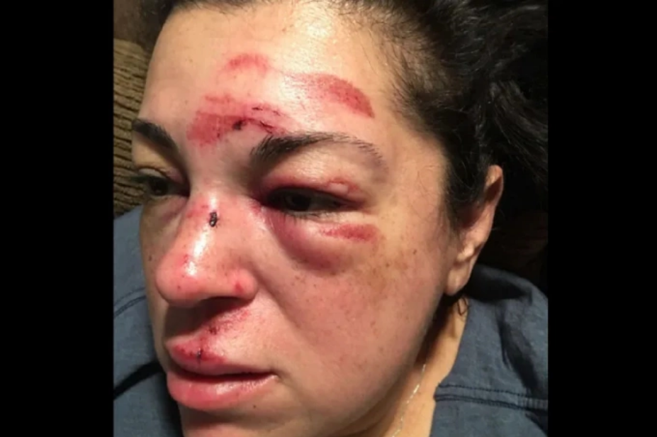 Justine Gurrola, 42 tuổi, một giáo viên giáo dục đặc biệt đã bị ngã khi đang đi dạo trên vỉa hè thành phố Whittier, bang California, tháng 2/2018. Ảnh: NBC