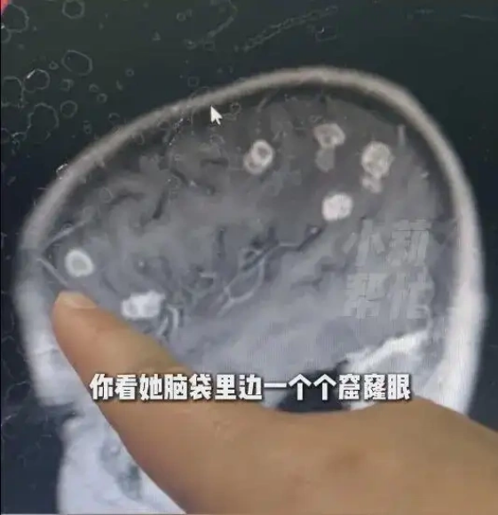 Những lỗ hổng bị nấm ăn trong não bé gái 6 tuổi, sau khi dọn nhà đón Tết với gia đình. Ảnh: Qianjiang Evening News