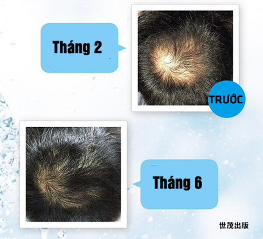 Ở tuổi 40+, chuyên gia làm đẹp thêm thứ này vào nước gội đầu, tóc mọc dày lại chỉ sau 4 tháng, đầu sạch bong - 1